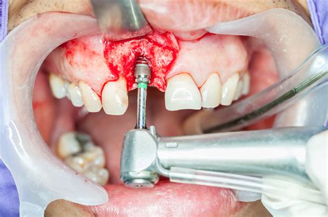 Bone Grafting .